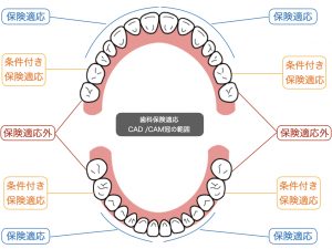 盛岡の歯医者｜栃内歯科医院｜CAD /CAM保険適応範囲