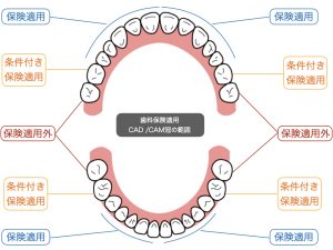 CAD /CAM冠保険適用範囲