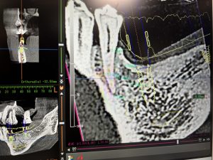 インプラント　治療計画