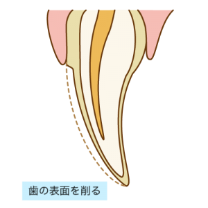 ラミネートベニア形成