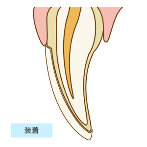 ラミネートベニア装着