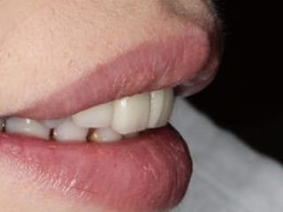 スマイルラインから診る前歯の審美歯科治療