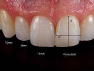 歯の標準的な長さ