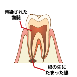 汚染された歯髄