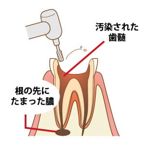 根管開放