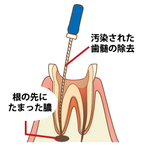 根管治療