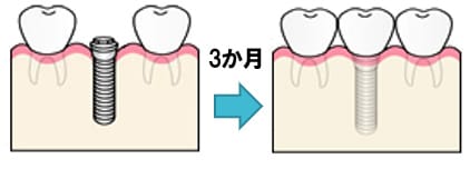 インプラントオーバーデンチャー