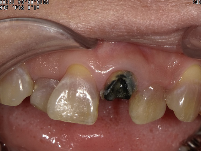盛岡(盛岡市)の歯医者、医療法人啓仁会 栃内歯科医院歯を残す治療