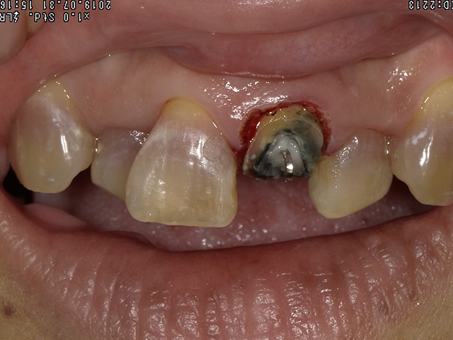 盛岡(盛岡市)の歯医者、医療法人啓仁会 栃内歯科医院の歯を残す治療